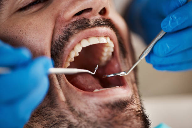 Best Emergency Tooth Extraction in Redway, CA