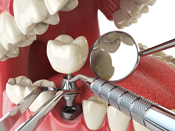 Best Emergency Tooth Extraction in Redway, CA